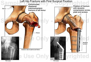hip fracture