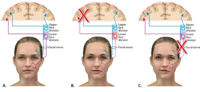 facial palsy weakness stroke innervation exosomes jems differentiating rechargebiomedical