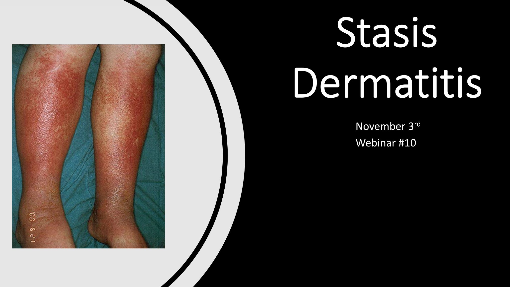 Webinar #10 – Stasis Dermatitis – Recharge Biomedical